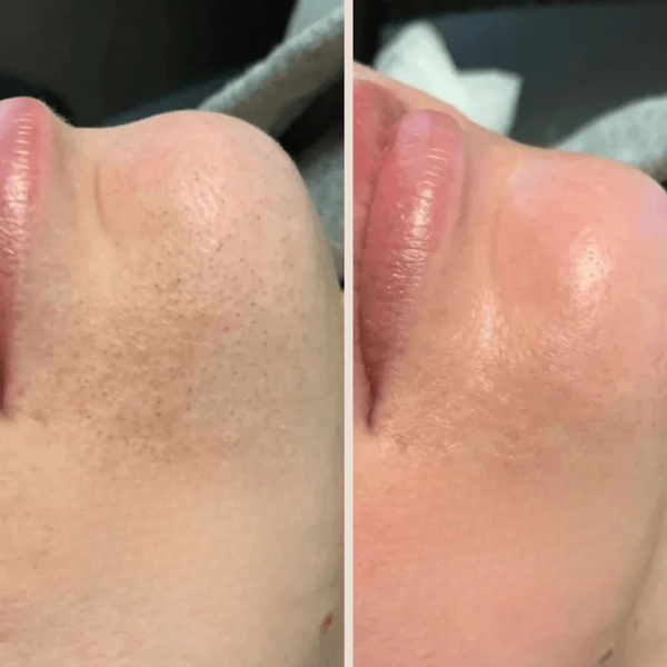 Exfolie ta peau sans la brûler – Peeling doux au riz pour peaux sensibles