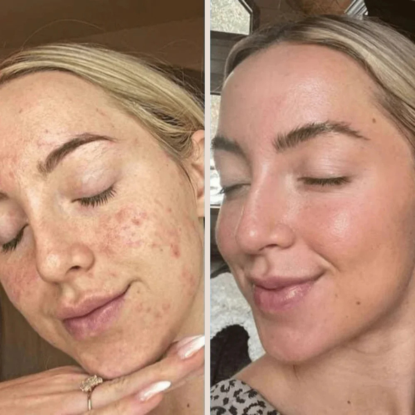 Exfolie ta peau sans la brûler – Peeling doux au riz pour peaux sensibles