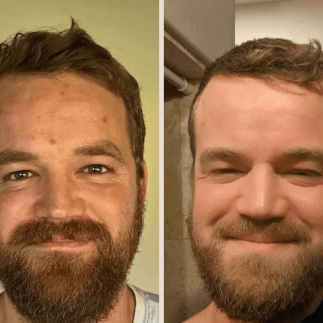 Exfolie ta peau sans la brûler – Peeling doux au riz pour peaux sensibles